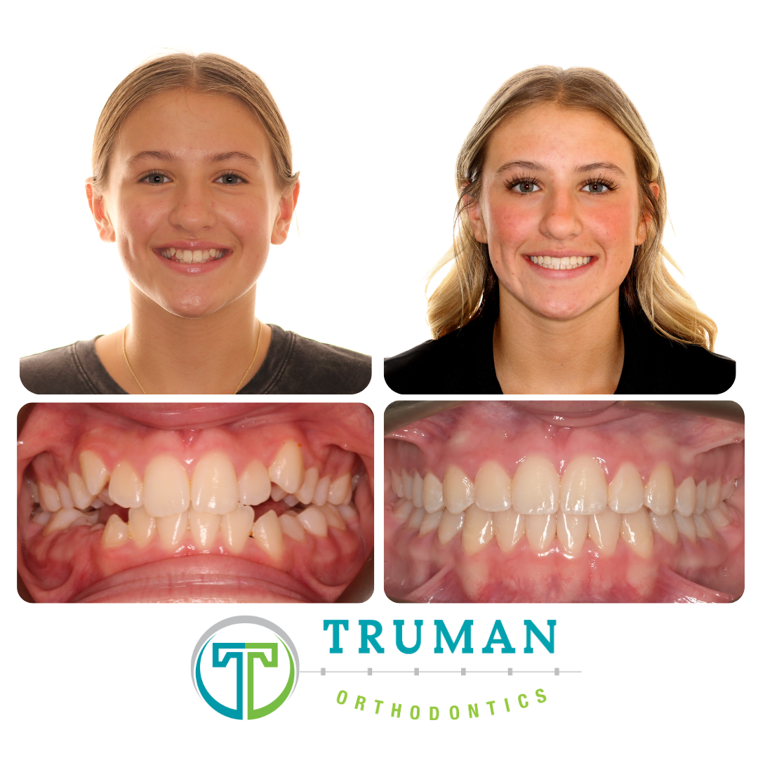 Smile Transformation