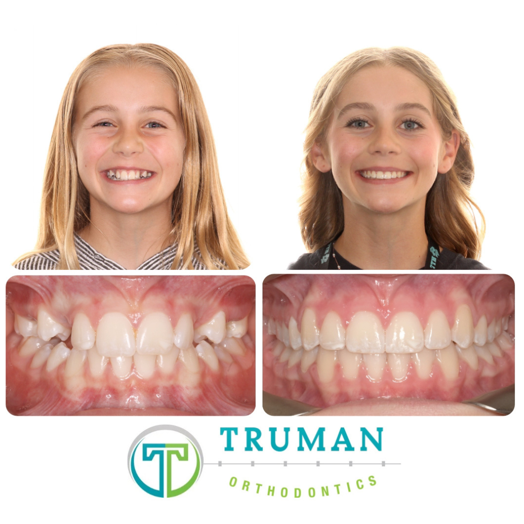 Smile Transformation