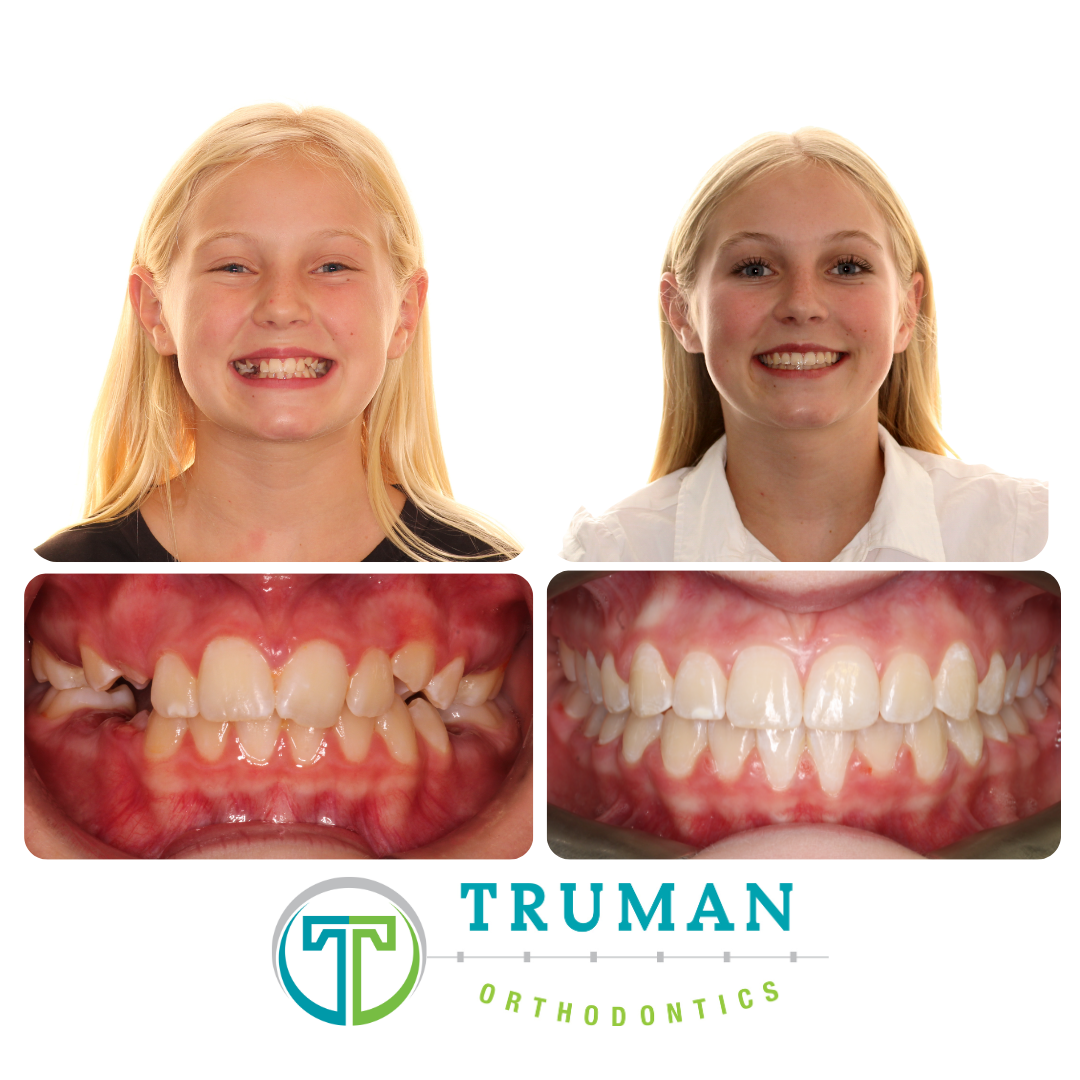 Smile Transformation