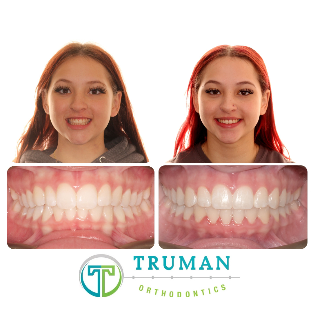 Smile Transformation