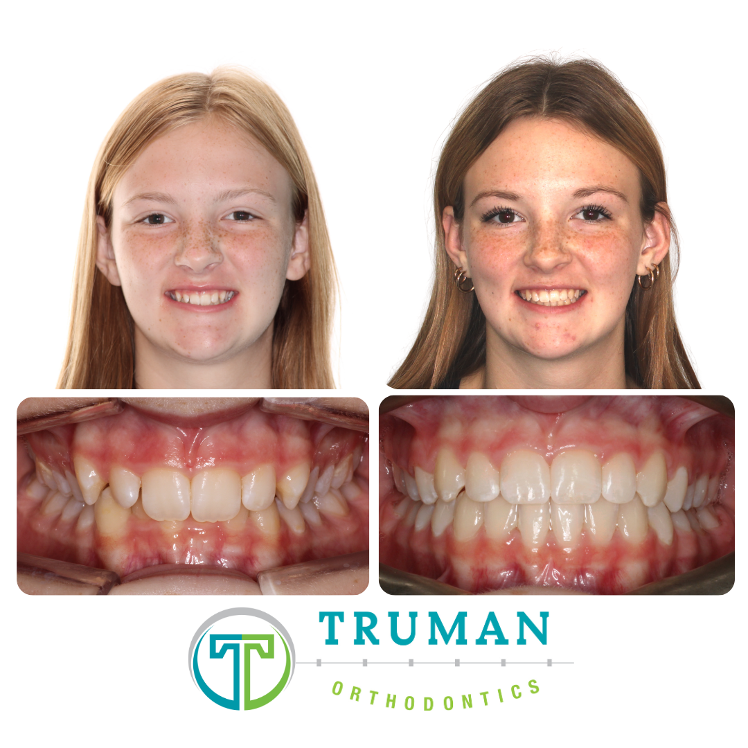 Smile Transformation