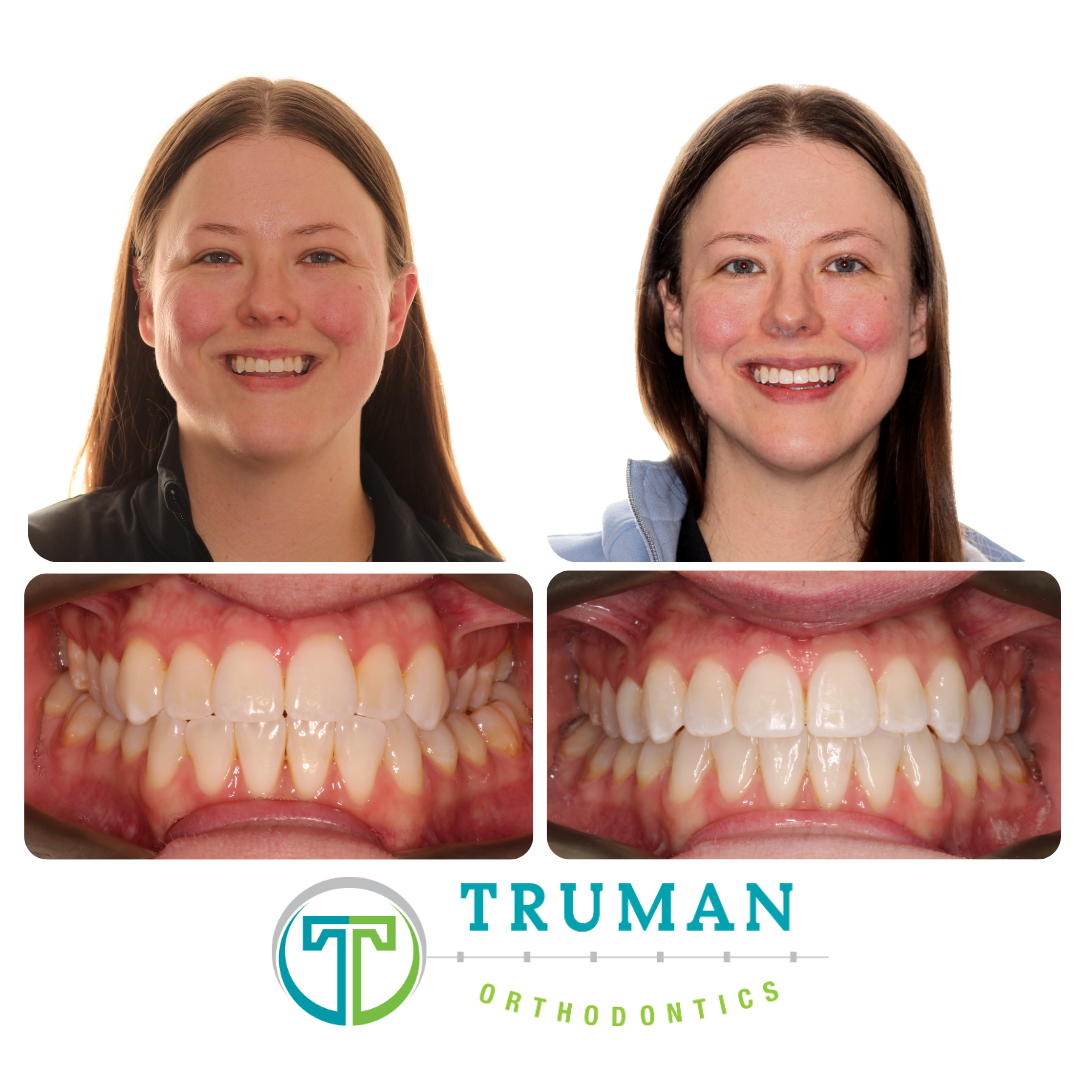 Smile Transformation