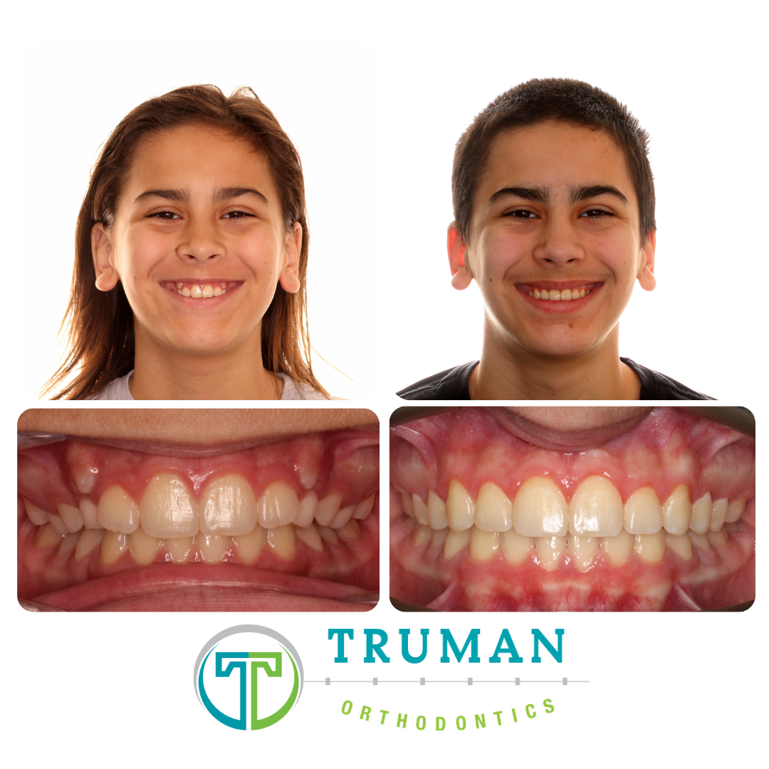 Smile Transformation