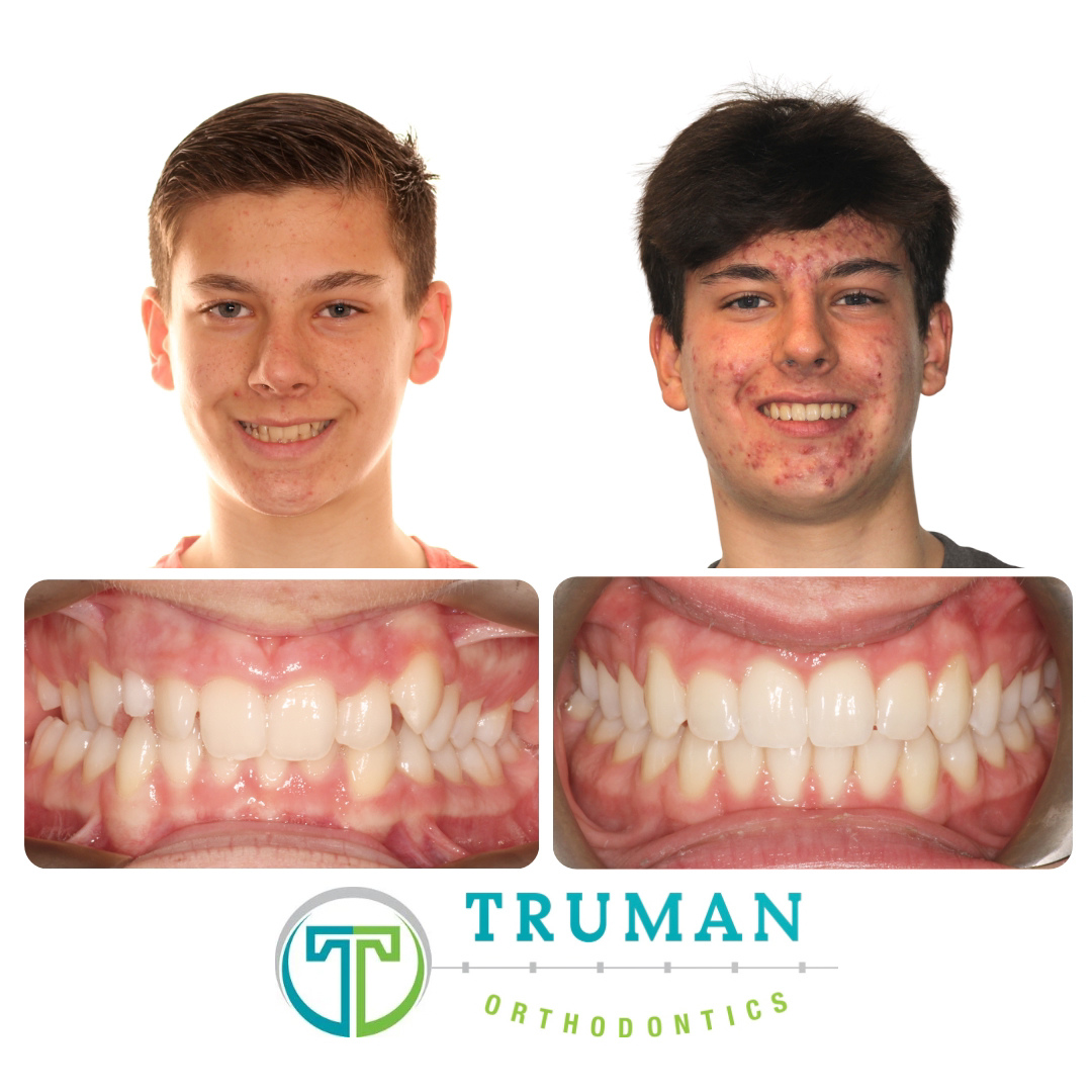 Smile Transformation