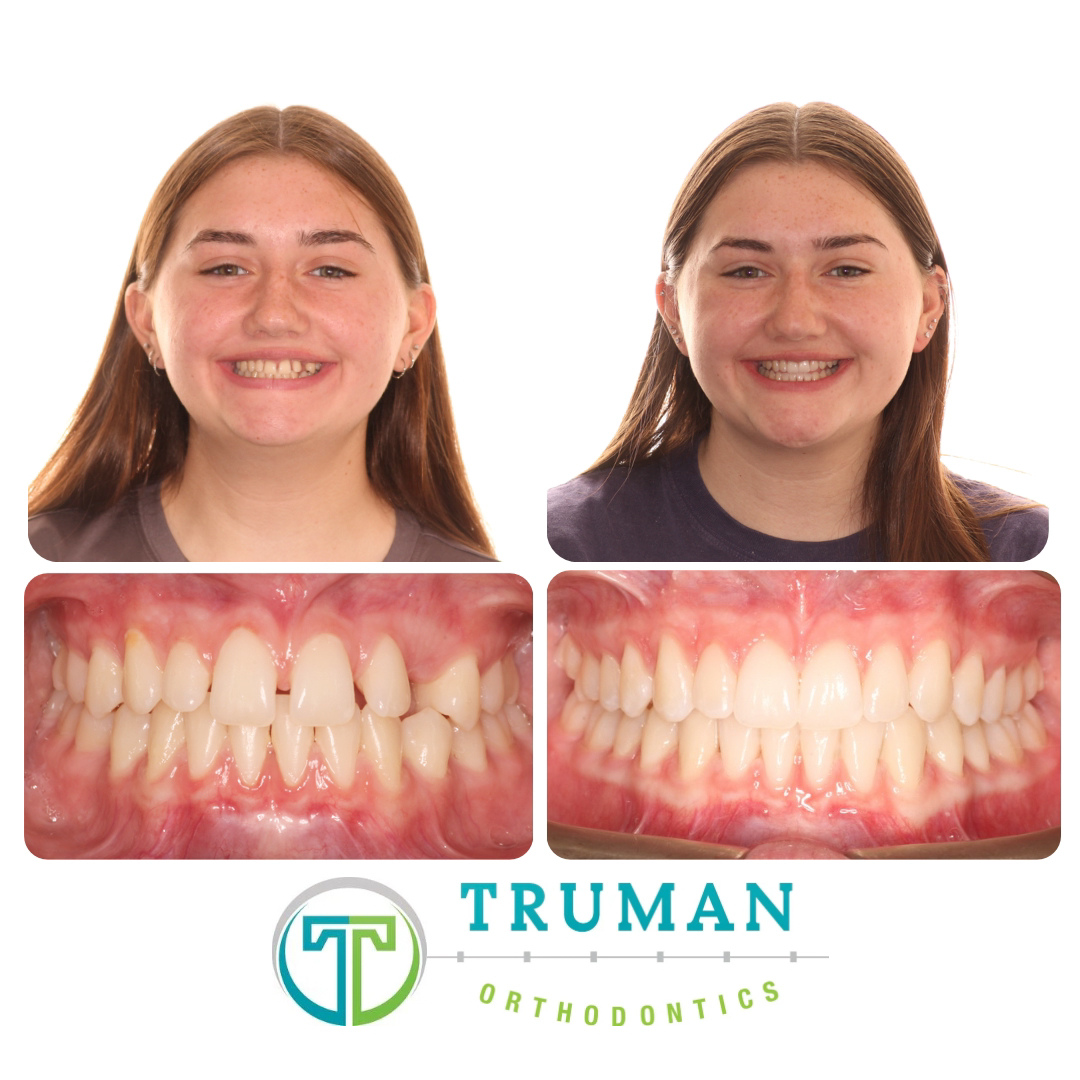 Smile Transformation