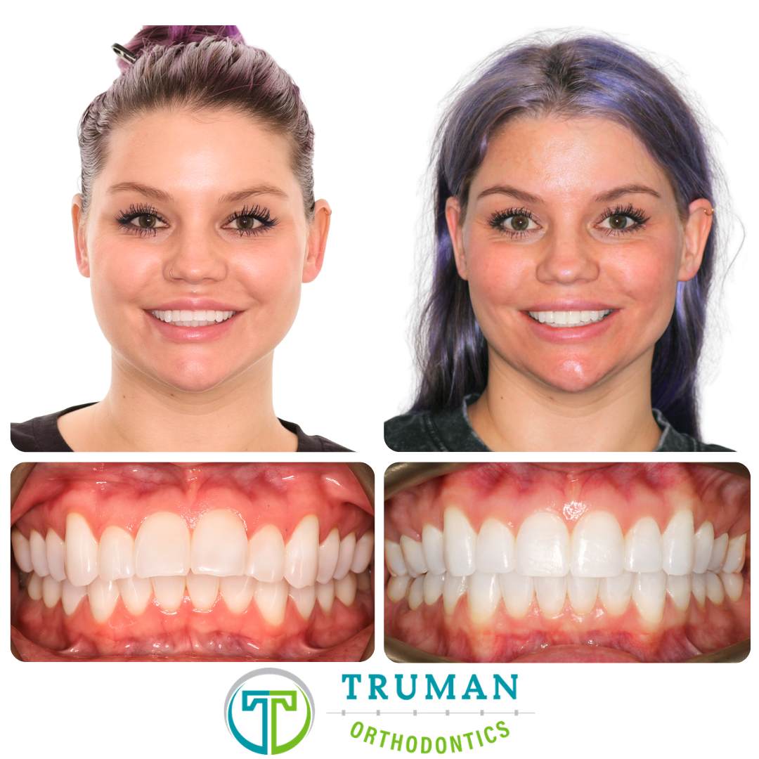 Smile Transformation