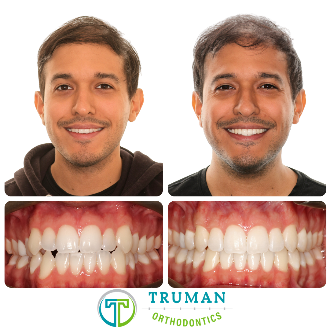 Smile Transformation