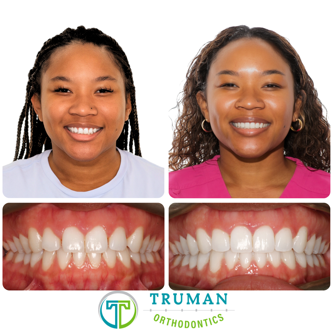 Smile Transformation