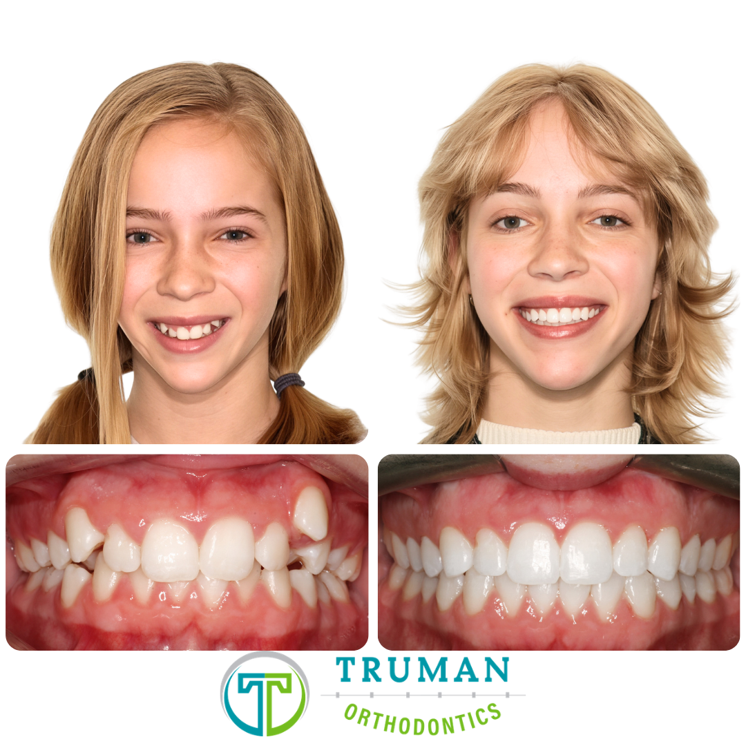 Smile Transformation