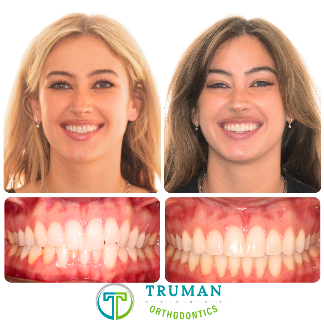 Smile Transformation