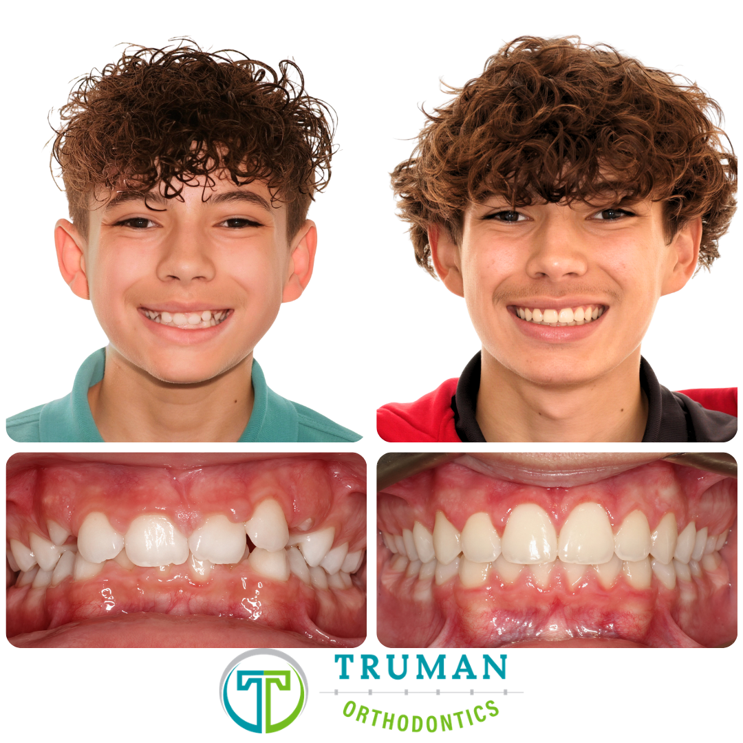 Smile Transformation