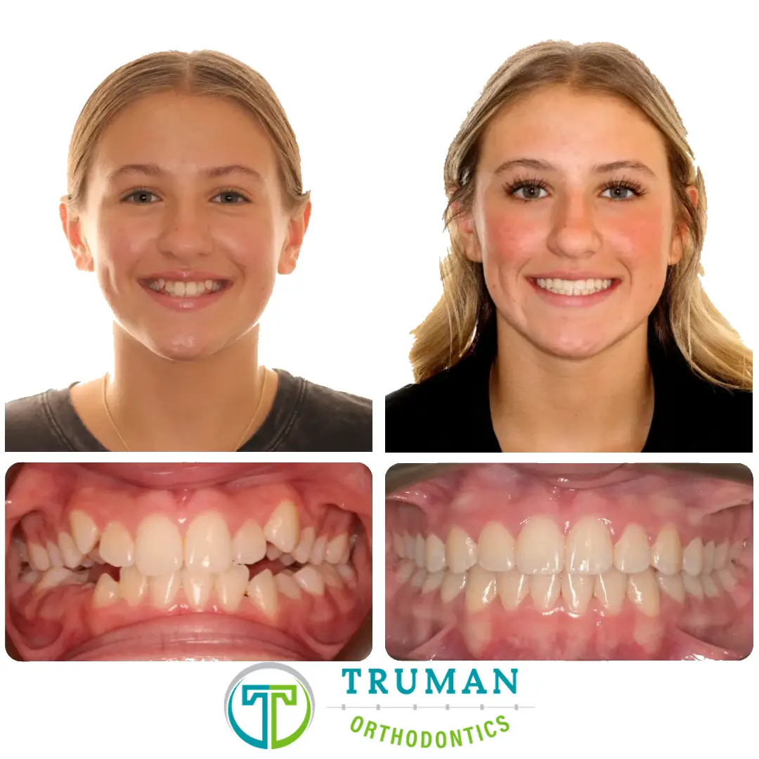 Smile Transformation