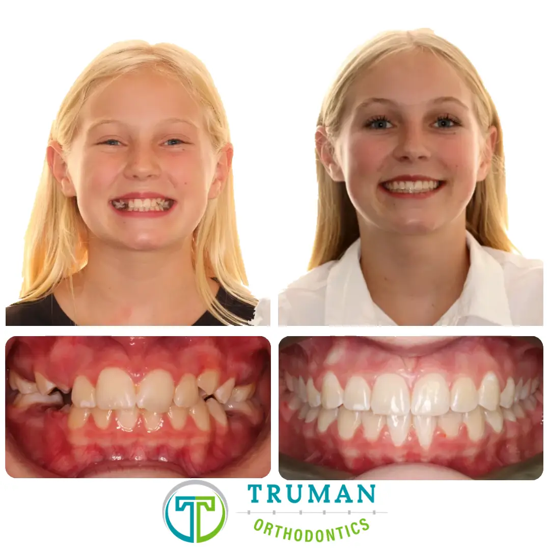 Smile Transformation