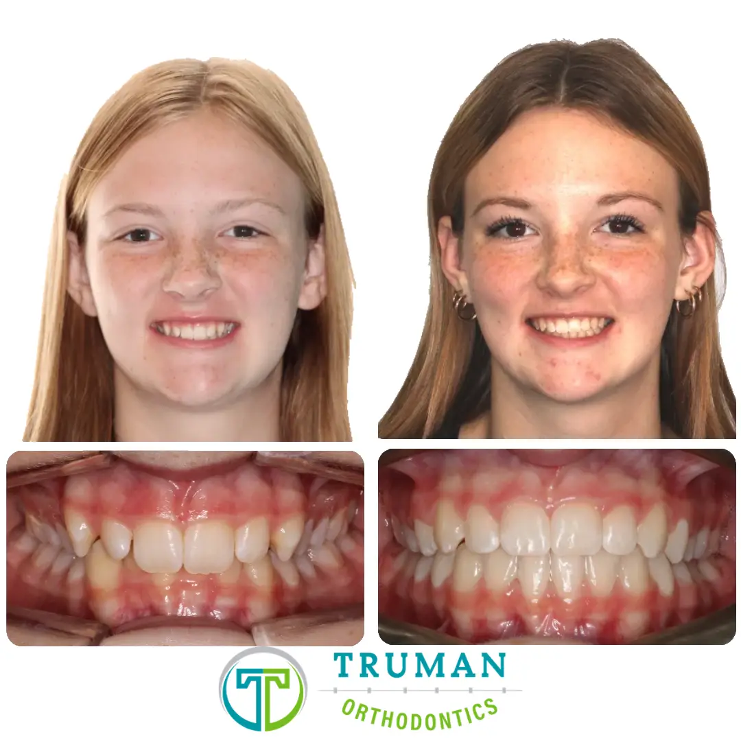 Smile Transformation