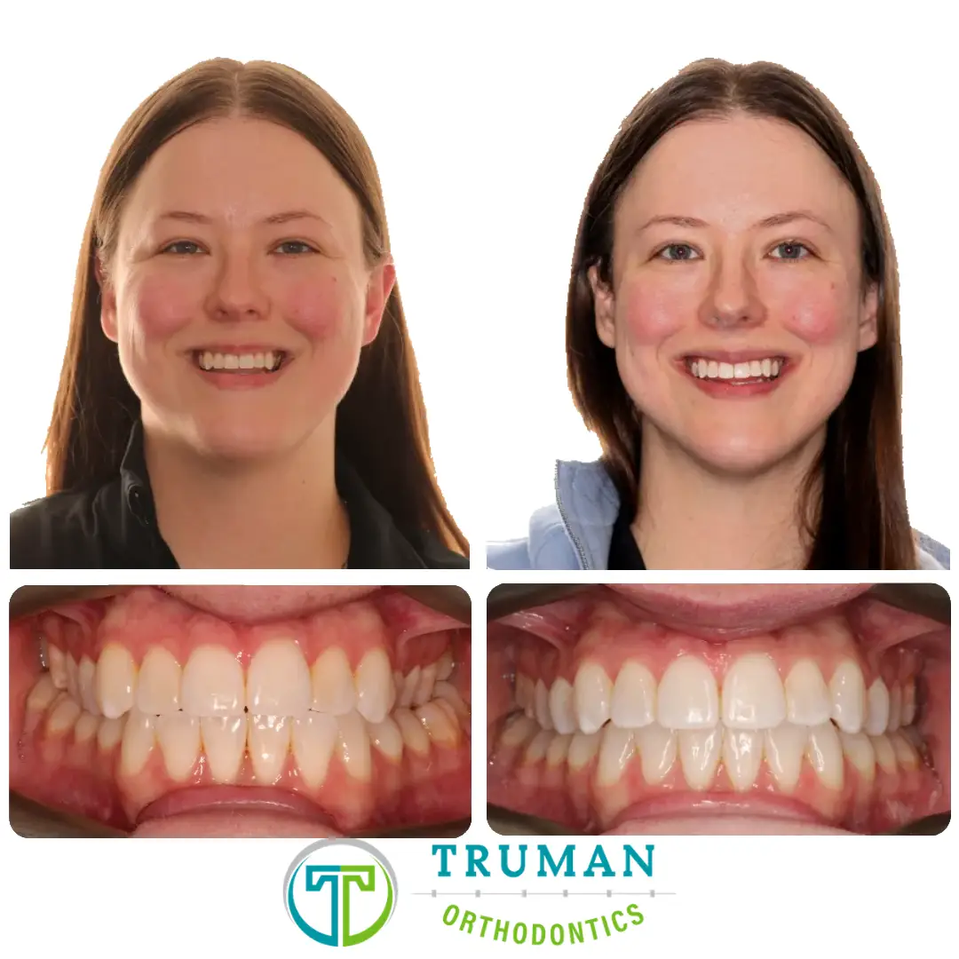 Smile Transformation