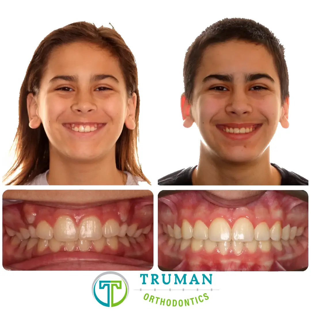 Smile Transformation
