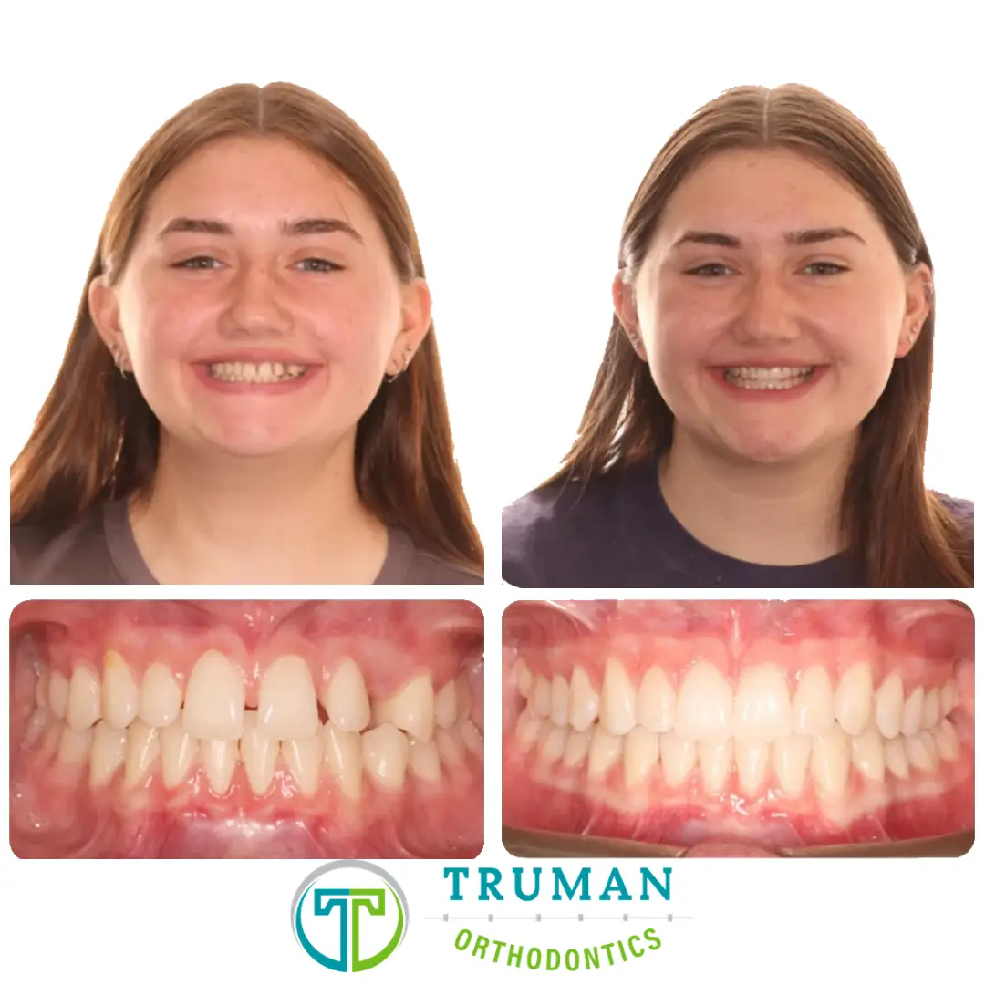 Smile Transformation